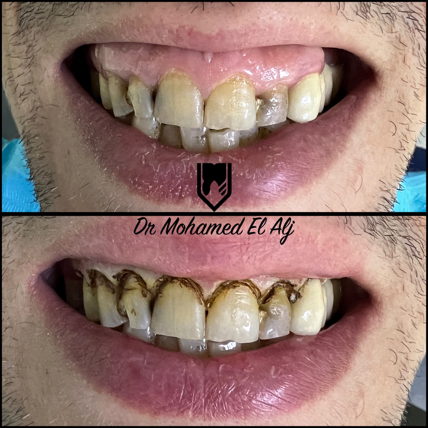 Remise en état des dents abîmées — Centre Dentaire El Alj Fès